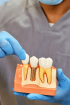 Implante dentário - Unique Dental Care